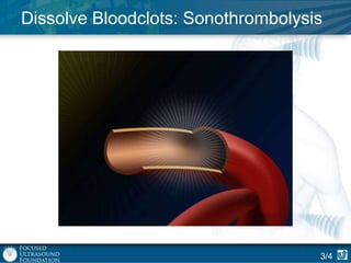 Dissolve Bloodclots: Sonothrombolysis

3/4

 