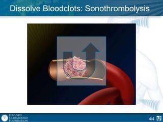 Dissolve Bloodclots: Sonothrombolysis

4/4

 
