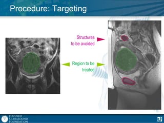 Procedure: Targeting

Structures
to be avoided

Region to be
treated

 