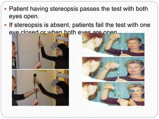  Patient having stereopsis passes the test with both
eyes open.
 If stereopsis is absent, patients fail the test with one
eye closed or when both eyes are open.
 