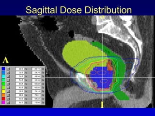 Future Developments In Radiation Therapy For Prostate Cancer | PDF