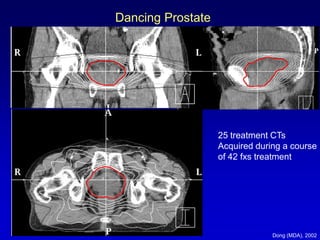 Future Developments In Radiation Therapy For Prostate Cancer | PDF