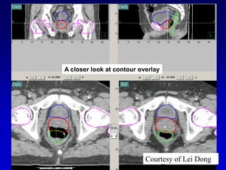 Future Developments In Radiation Therapy For Prostate Cancer | PDF