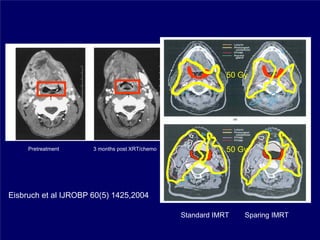 50 Gy




     Pretreatment     3 months post XRT/chemo               50 Gy




Eisbruch et al IJROBP 60(5) 1425,2004

                                                Standard IMRT   Sparing IMRT
 