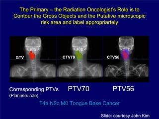 The Primary – the Radiation Oncologist’s Role is to
  Contour the Gross Objects and the Putative microscopic
             risk area and label appropriartely




   GTV                    CTV70           CTV56




Corresponding PTVs          PTV70            PTV56
(Planners role)
                  T4a N2c M0 Tongue Base Cancer

                                        Slide: courtesy John Kim
 