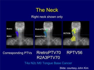 The Neck
                 Right neck shown only


  Rretro             RretroCTV70

                                         RCTV56
  R2A3               R2A3CTV70




Corresponding PTVs    RretroPTV70          RPTV56
                      R2A3PTV70
             T4a N2c M0 Tongue Base Cancer
                                   Slide: courtesy John Kim
 