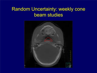 Random Uncertainty: weekly cone
        beam studies
 