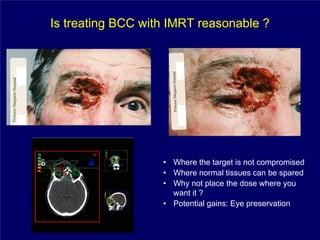 Is treating BCC with IMRT reasonable ?




                   • Where the target is not compromised
                   • Where normal tissues can be spared
                   • Why not place the dose where you
                     want it ?
                   • Potential gains: Eye preservation
 