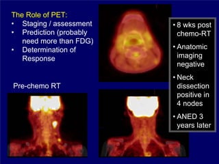 The Role of PET:
• Staging / assessment   • 8 wks post
• Prediction (probably     chemo-RT
   need more than FDG)
• Determination of       • Anatomic
   Response                imaging
                           negative
                         • Neck
Pre-chemo RT               dissection
                           positive in
                           4 nodes
                         • ANED 3
                           years later
 