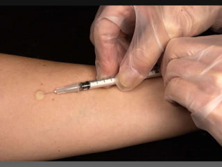 Cutaneous Tuberculosis