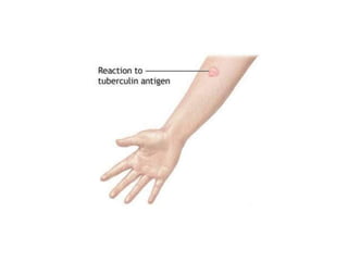 Cutaneous Tuberculosis