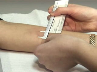 Cutaneous Tuberculosis