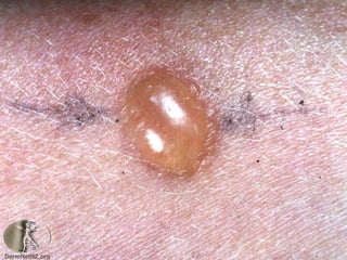 Cutaneous Tuberculosis