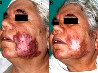 Cutaneous Tuberculosis