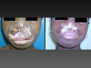 Cutaneous Tuberculosis