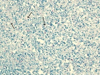 Cutaneous Tuberculosis