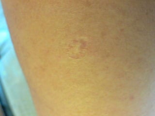 Cutaneous Tuberculosis