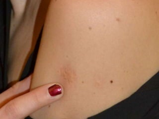 Cutaneous Tuberculosis