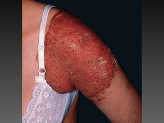 Cutaneous Tuberculosis