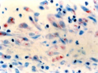 Cutaneous Tuberculosis