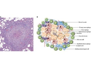 Cutaneous Tuberculosis