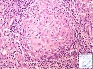 Cutaneous Tuberculosis