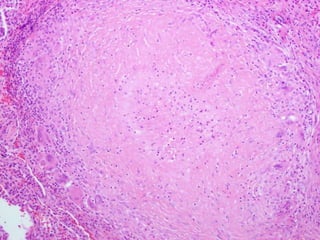 Cutaneous Tuberculosis