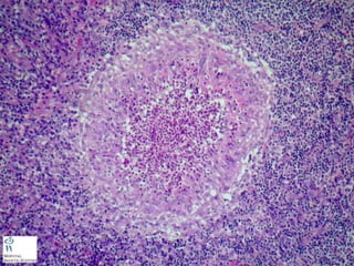 Cutaneous Tuberculosis