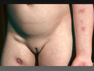 Cutaneous Tuberculosis