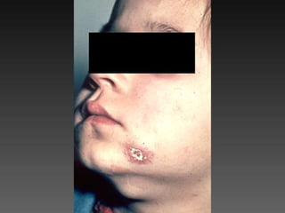 Cutaneous Tuberculosis