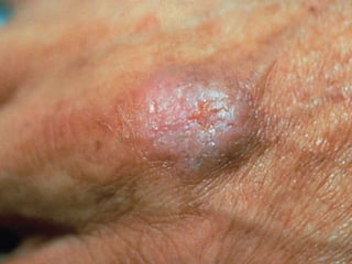 Cutaneous Tuberculosis