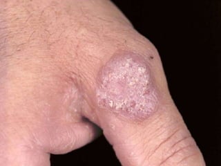 Cutaneous Tuberculosis