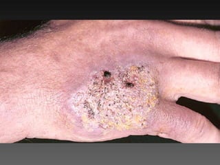 Cutaneous Tuberculosis