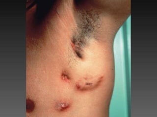 Cutaneous Tuberculosis