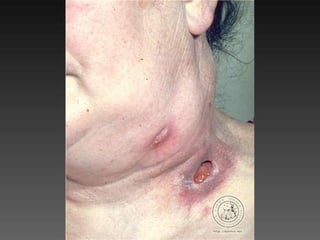 Cutaneous Tuberculosis