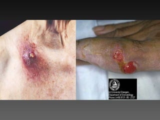 Cutaneous Tuberculosis