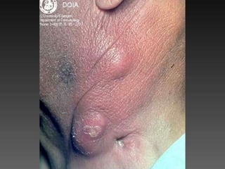 Cutaneous Tuberculosis
