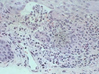 Cutaneous Tuberculosis