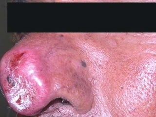 Cutaneous Tuberculosis