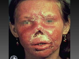 Cutaneous Tuberculosis