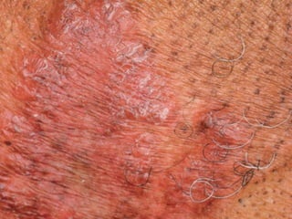 Cutaneous Tuberculosis