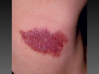 Cutaneous Tuberculosis