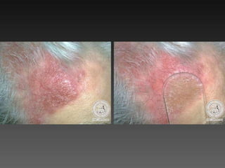 Cutaneous Tuberculosis