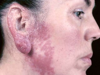 Cutaneous Tuberculosis