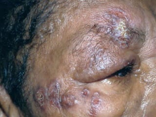 Cutaneous Tuberculosis