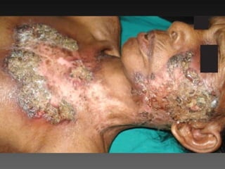 Cutaneous Tuberculosis