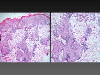 Cutaneous Tuberculosis