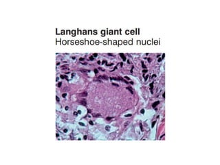 Cutaneous Tuberculosis