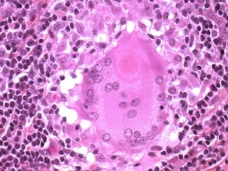 Cutaneous Tuberculosis