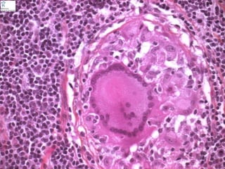 Cutaneous Tuberculosis